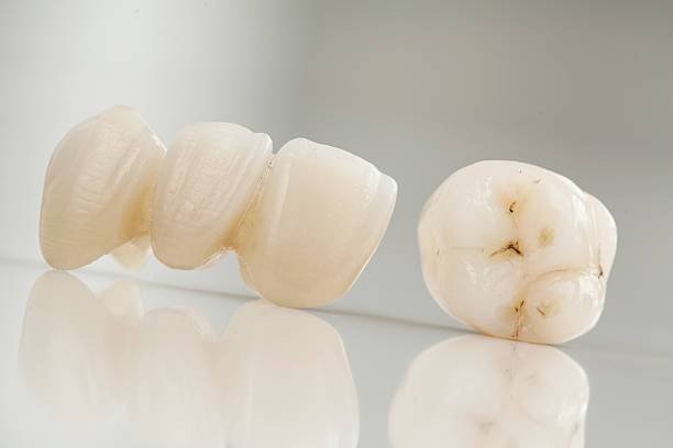 Ceramic bridge dental Images