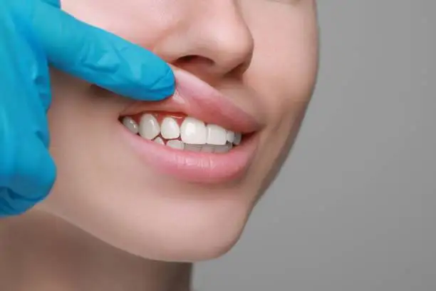 Signs of Gum Disease Image