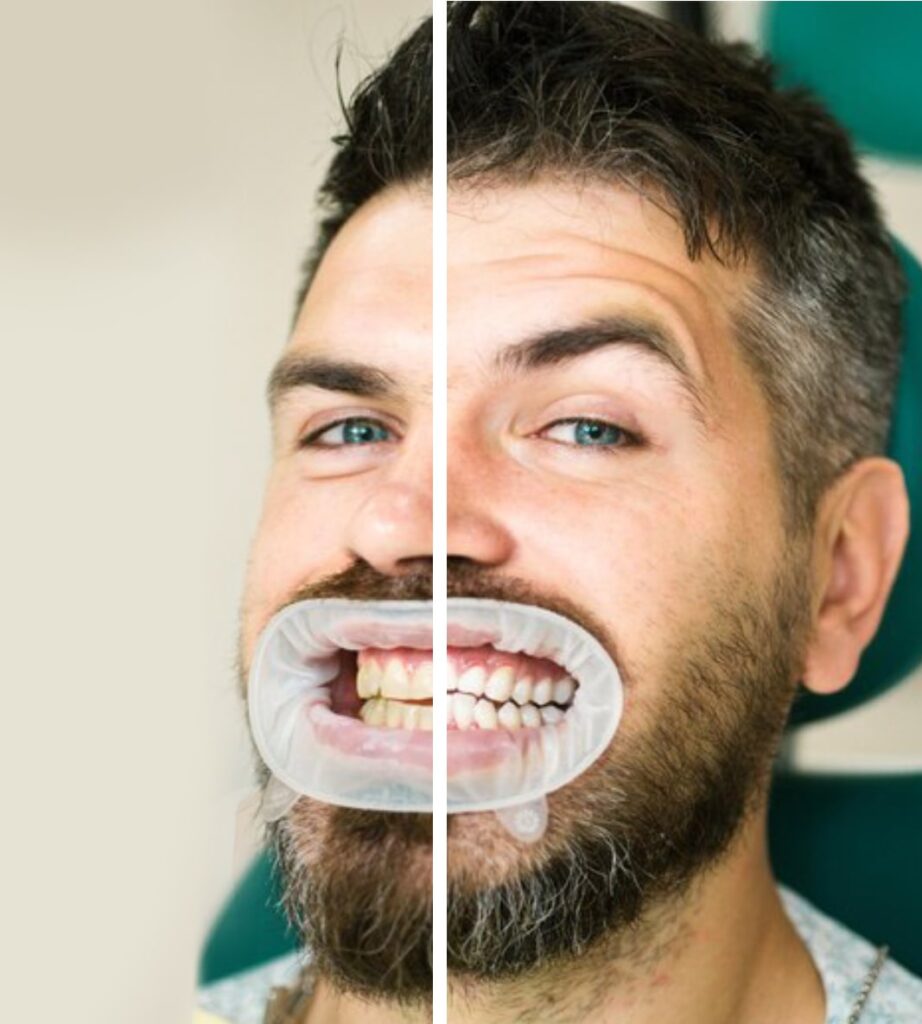 Teeth whitening after & Before Image