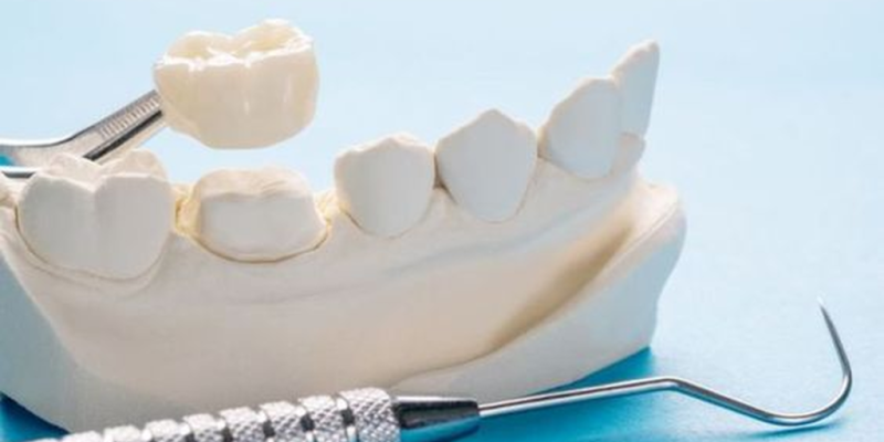 Dental Crowns and Bridges Image