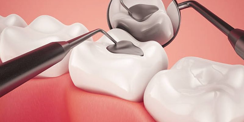Tooth Colored Fillings Image