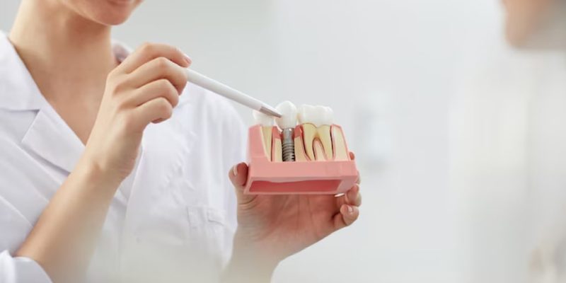 Dental Implants for Patients Images