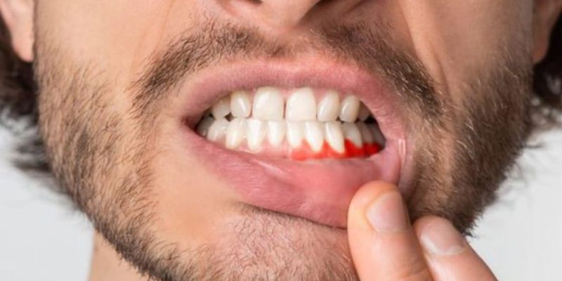 Gum Disease Contagious Image