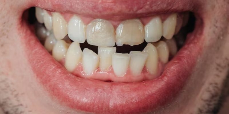 chipped tooth images